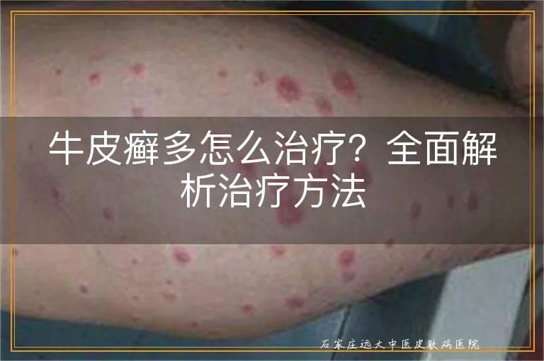 牛皮癣多怎么治疗？全面解析治疗方法