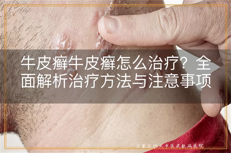 牛皮癣牛皮癣怎么治疗？全面解析治疗方法与注意事项