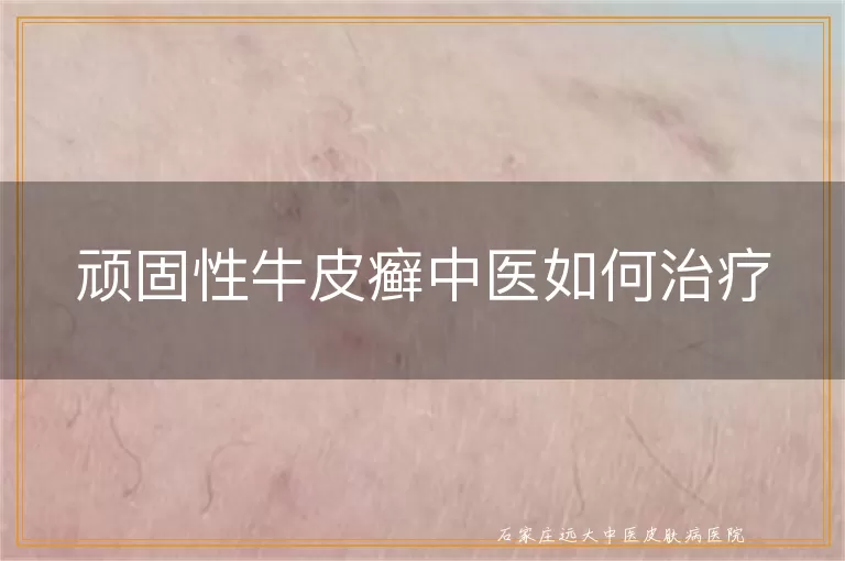 顽固性牛皮癣中医如何治疗