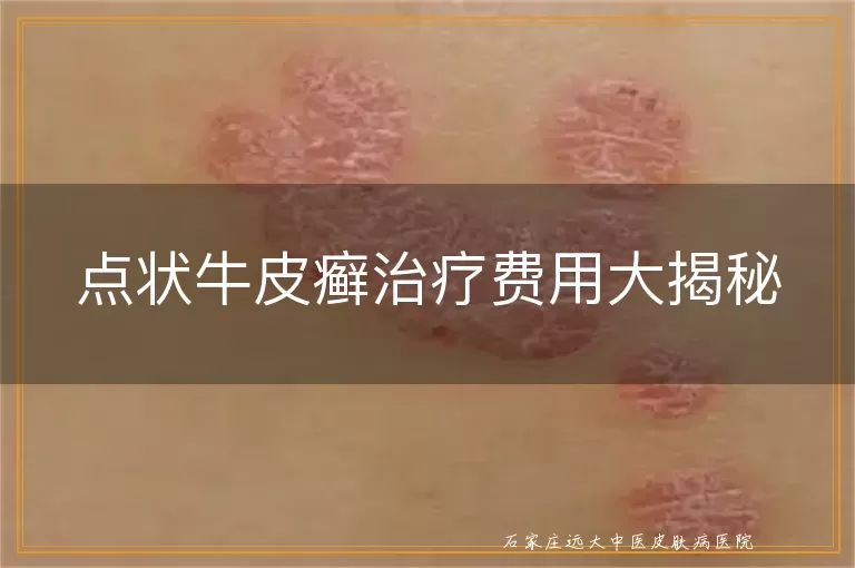点状牛皮癣治疗费用大揭秘