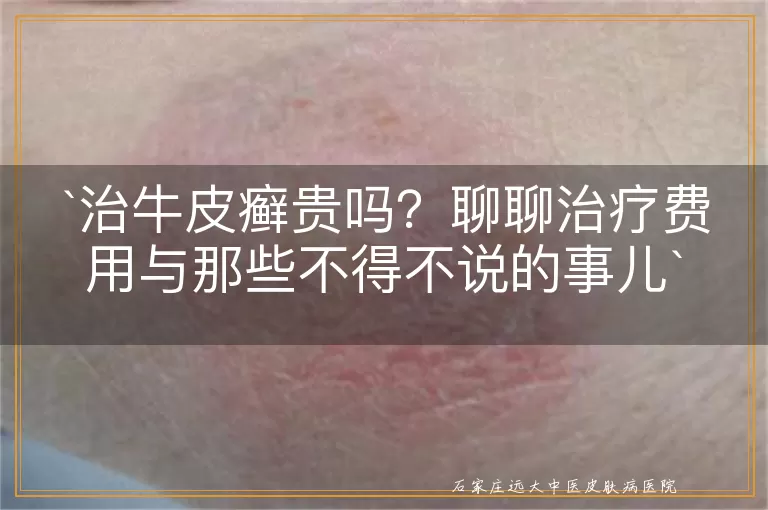 治牛皮癣贵吗？聊聊治疗费用与那些不得不说的事儿