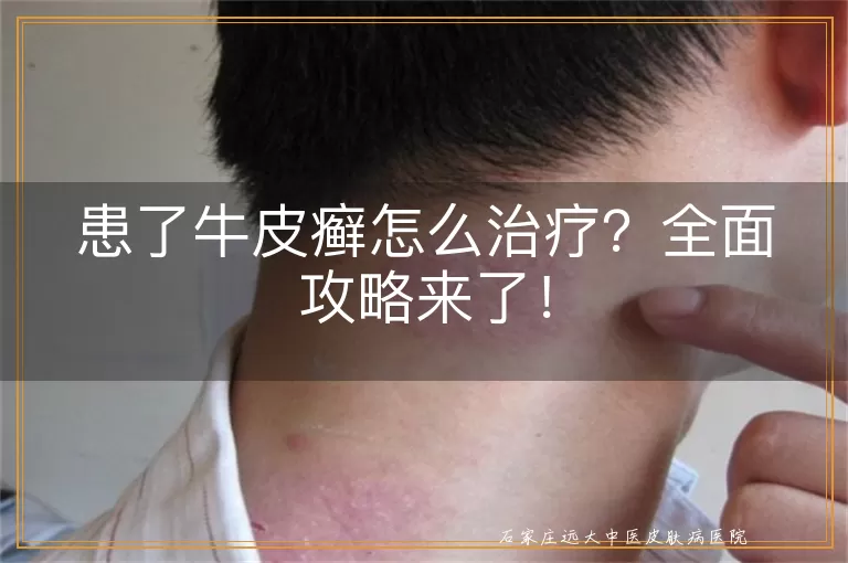 患了牛皮癣怎么治疗?全面攻略来了!