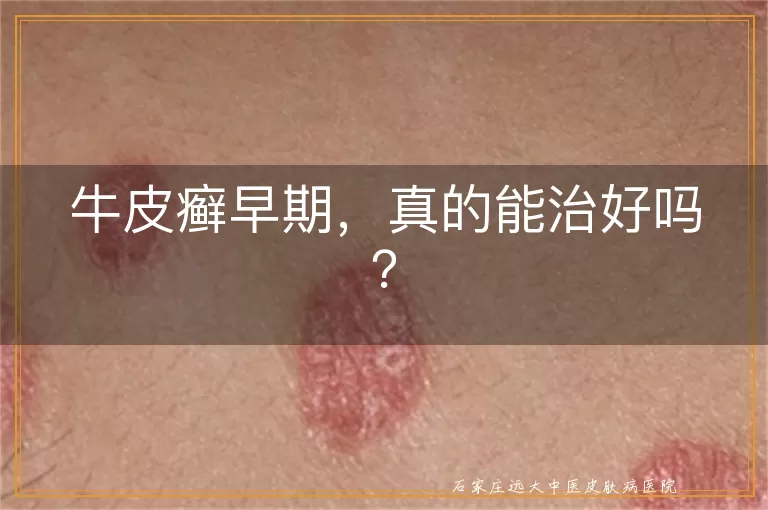 牛皮癣早期，真的能治好吗？