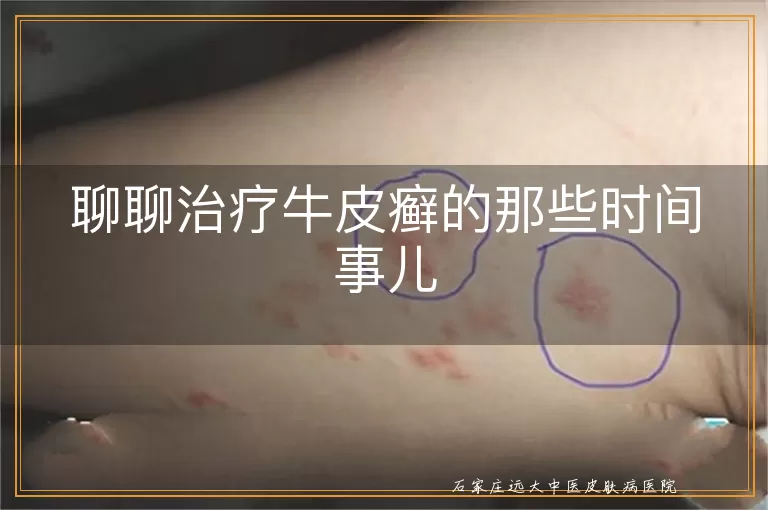 聊聊治疗牛皮癣的那些时间事儿