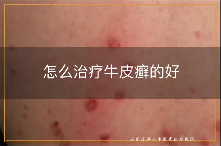 怎么治疗牛皮癣的好