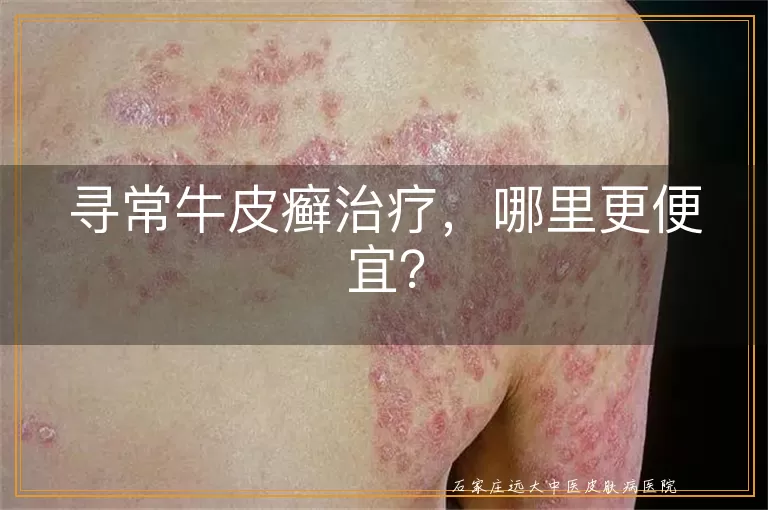 寻常牛皮癣治疗,哪里更便宜?