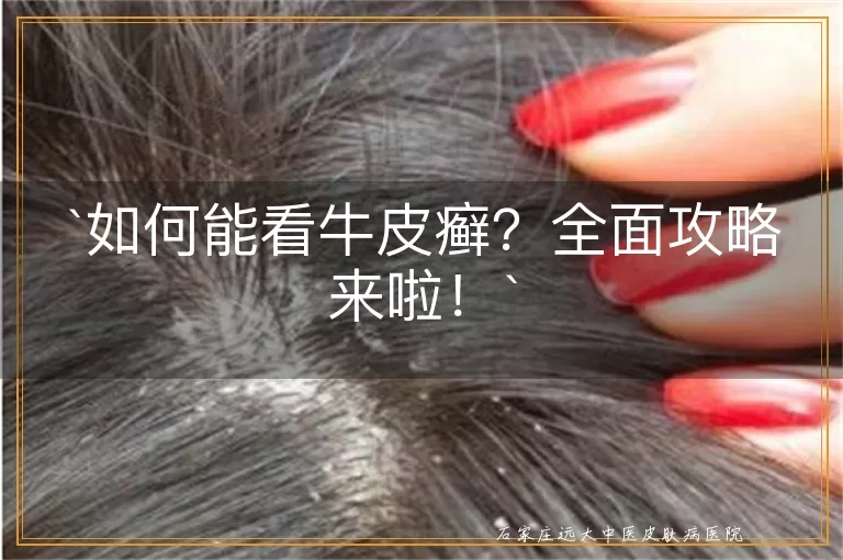 如何能看牛皮癣？全面攻略来啦！