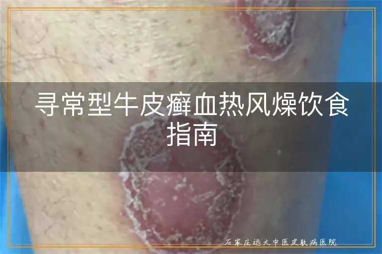 寻常型牛皮癣血热风燥饮食指南