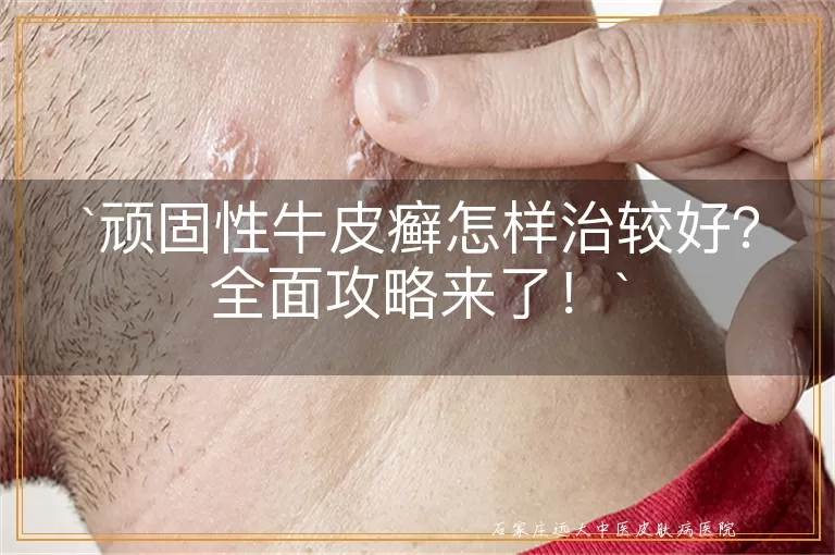 顽固性牛皮癣怎样治较好？全面攻略来了！