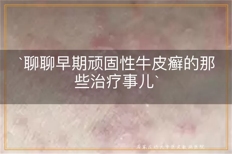 聊聊早期顽固性牛皮癣的那些治疗事儿