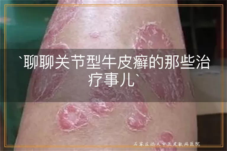 聊聊关节型牛皮癣的那些治疗事儿
