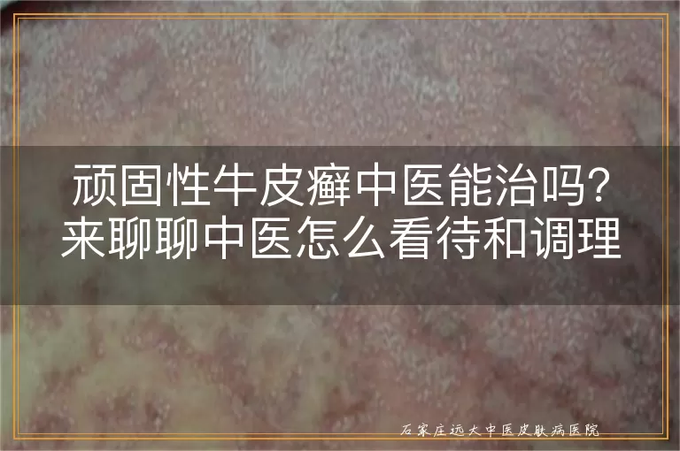 顽固性牛皮癣中医能治吗?来聊聊中医怎么看待和调理这病