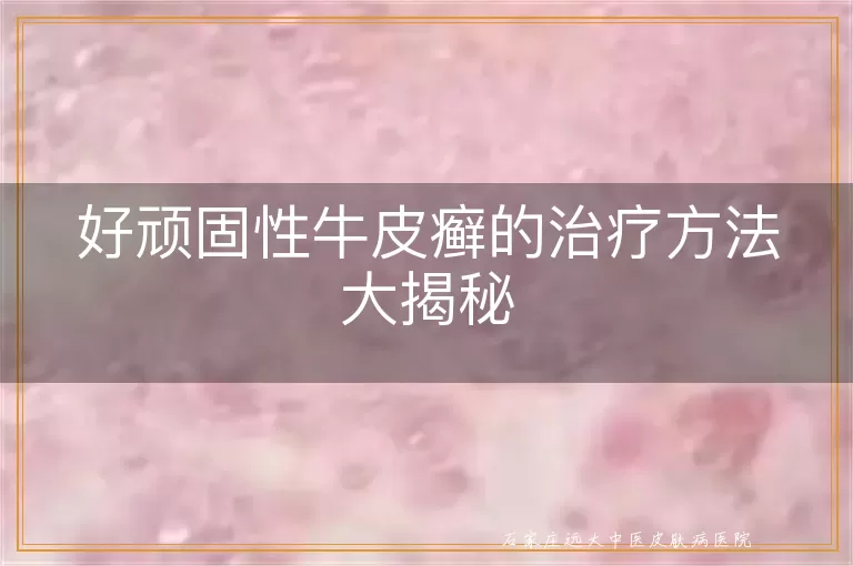 好顽固性牛皮癣的治疗方法大揭秘