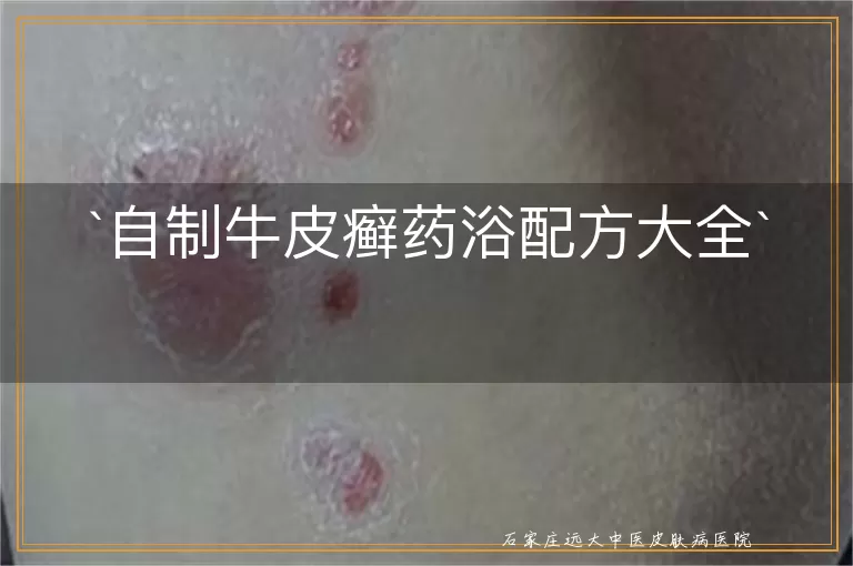 自制牛皮癣药浴配方大全