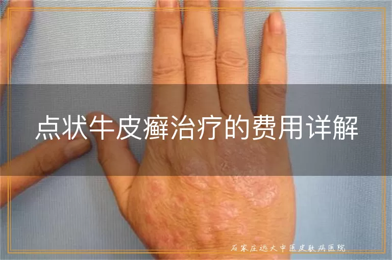 点状牛皮癣治疗的费用详解