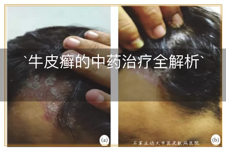牛皮癣的中药治疗全解析