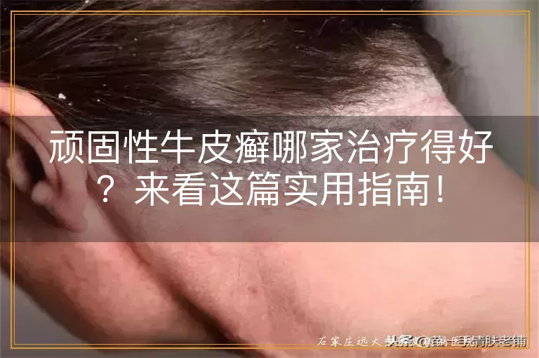 顽固性牛皮癣哪家治疗得好？来看这篇实用指南！