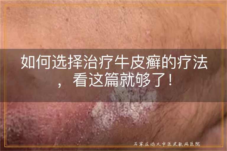 如何选择治疗牛皮癣的疗法,看这篇就够了!