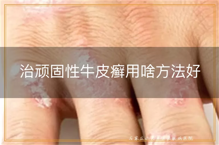 治顽固性牛皮癣用啥方法好