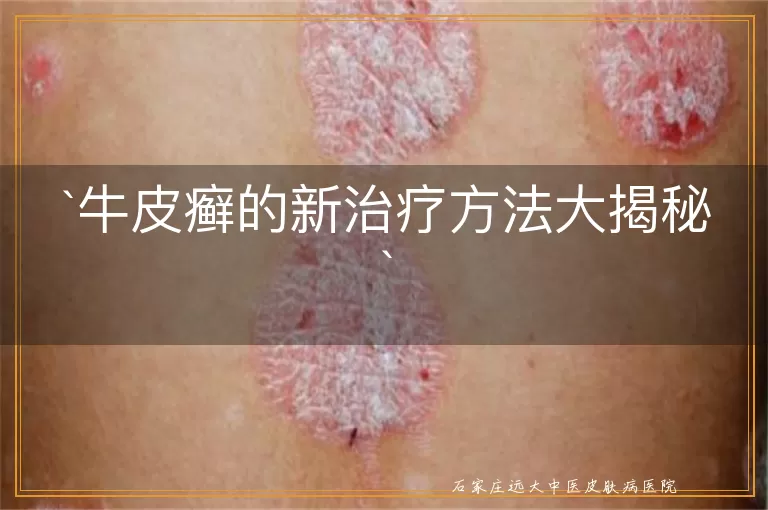 牛皮癣的新治疗方法大揭秘