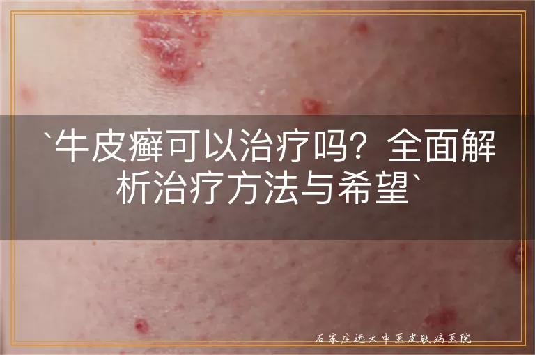 牛皮癣可以治疗吗？全面解析治疗方法与希望