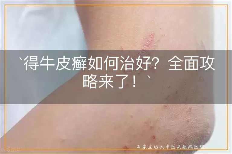 得牛皮癣如何治好？全面攻略来了！