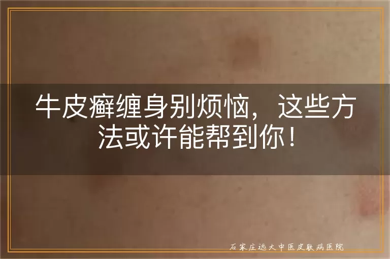 牛皮癣缠身别烦恼，这些方法或许能帮到你！