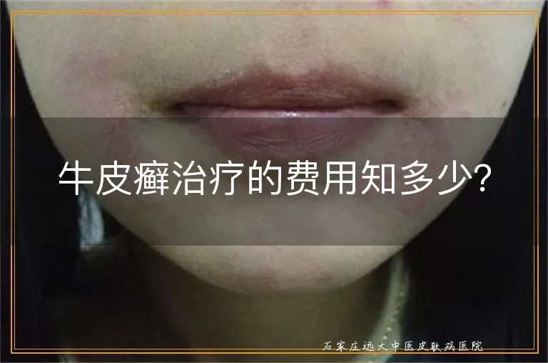 牛皮癣治疗的费用知多少？