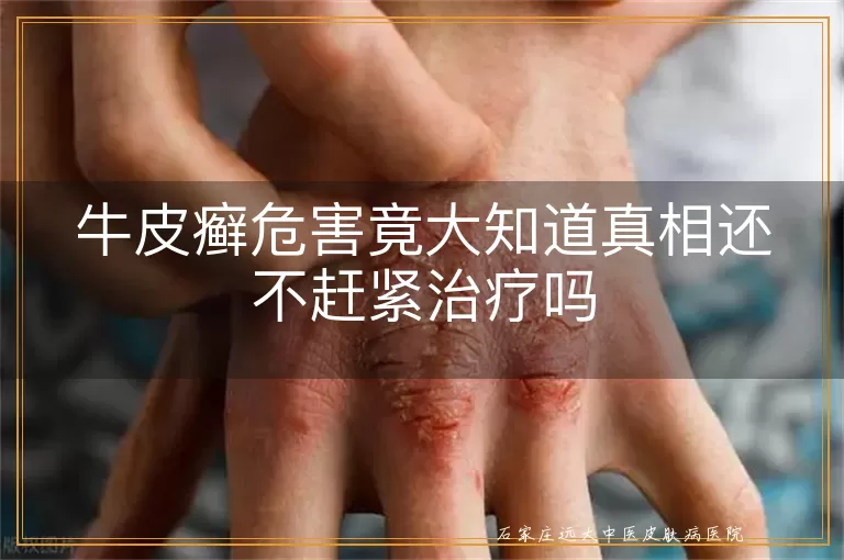牛皮癣危害竟大知道真相还不赶紧治疗吗