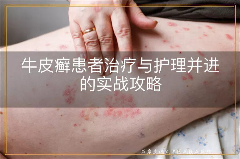 牛皮癣患者治疗与护理并进的实战攻略