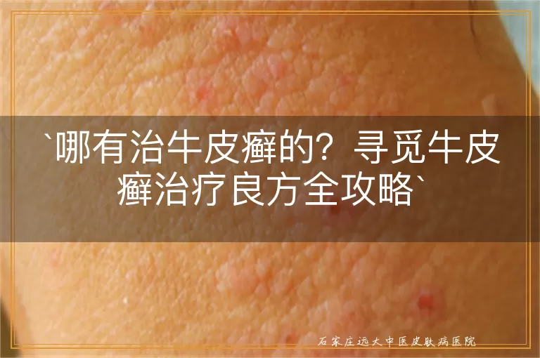 哪有治牛皮癣的？寻觅牛皮癣治疗良方全攻略