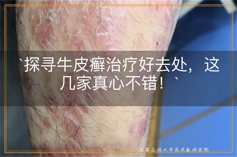 探寻牛皮癣治疗好去处，这几家真心不错！