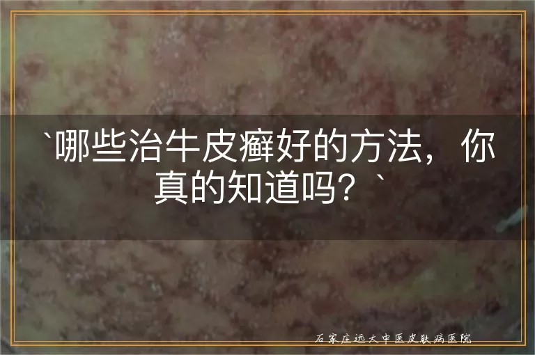 哪些治牛皮癣好的方法，你真的知道吗？