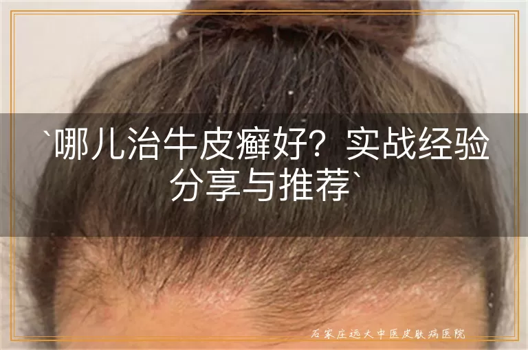 哪儿治牛皮癣好？实战经验分享与推荐