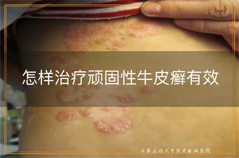 怎样治疗顽固性牛皮癣有效