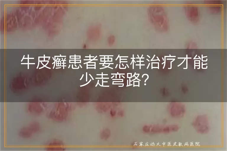 牛皮癣患者要怎样治疗才能少走弯路？