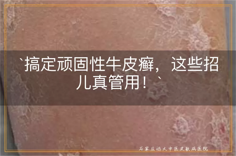 搞定顽固性牛皮癣，这些招儿真管用！