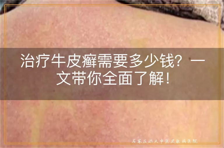 治疗牛皮癣需要多少钱？一文带你全面了解！