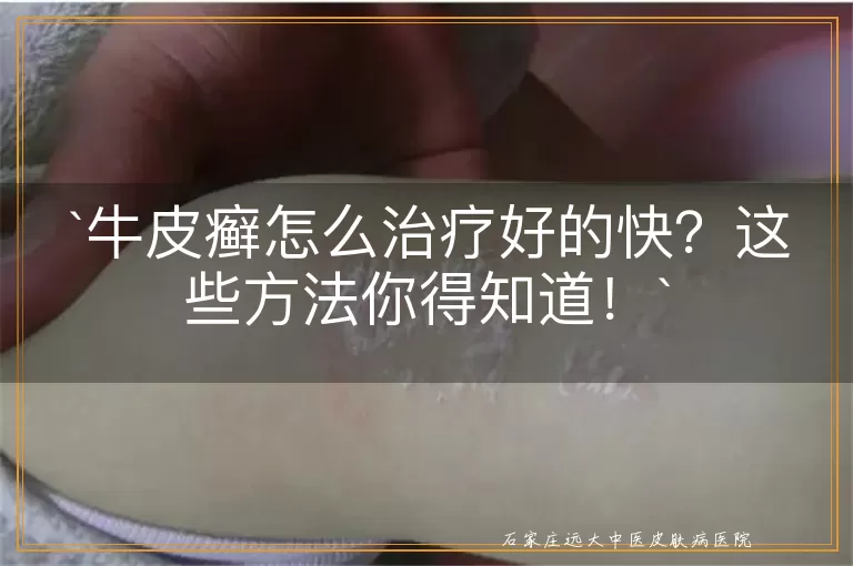 牛皮癣怎么治疗好的快？这些方法你得知道！