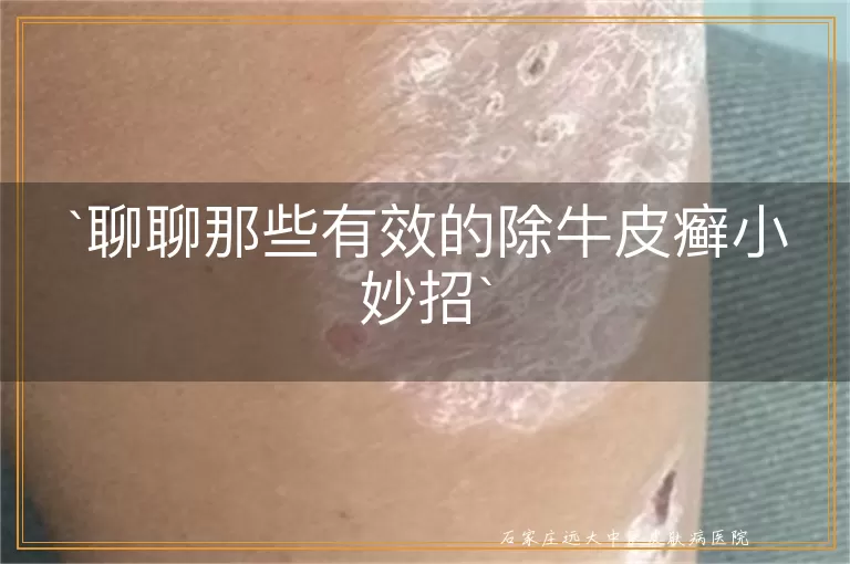 聊聊那些有效的除牛皮癣小妙招