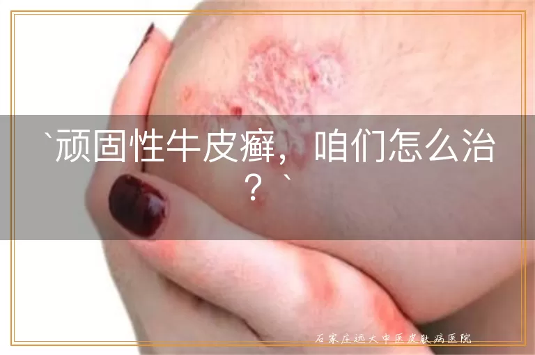 顽固性牛皮癣，咱们怎么治？
