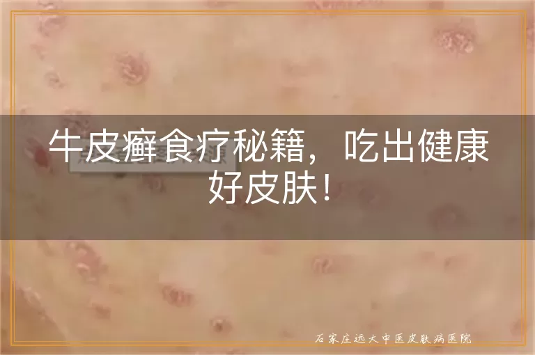 牛皮癣食疗秘籍，吃出健康好皮肤！