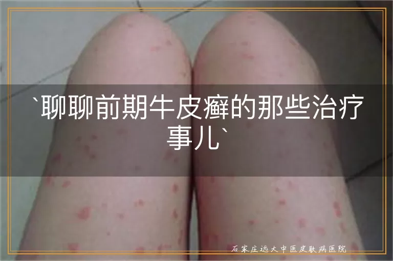 聊聊前期牛皮癣的那些治疗事儿