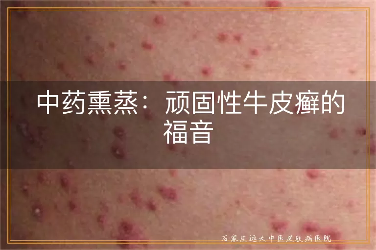 中药熏蒸：顽固性牛皮癣的福音
