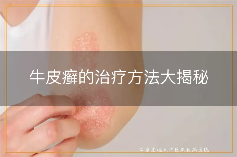 牛皮癣的治疗方法大揭秘