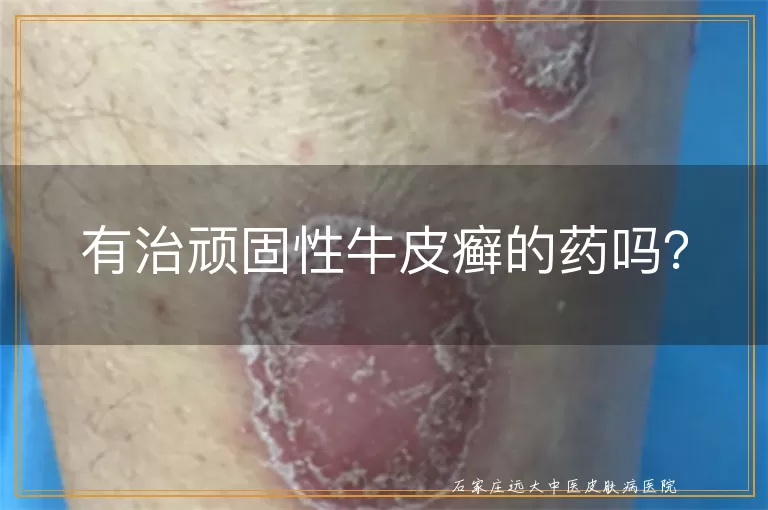 有治顽固性牛皮癣的药吗？