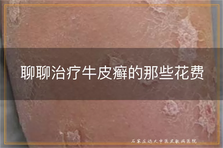 聊聊治疗牛皮癣的那些花费