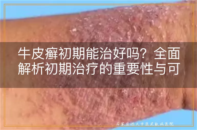 牛皮癣初期能治好吗？全面解析初期治疗的重要性与可行性