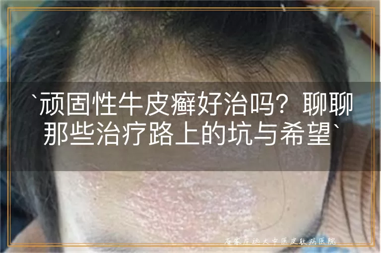 顽固性牛皮癣好治吗？聊聊那些治疗路上的坑与希望