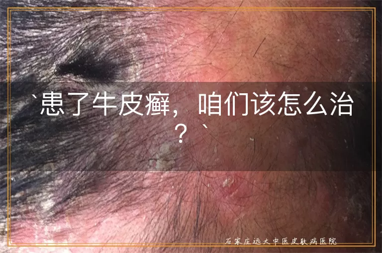 患了牛皮癣,咱们该怎么治?